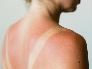 Bí quyết để da không tiết nhiều dầu trong mùa hè