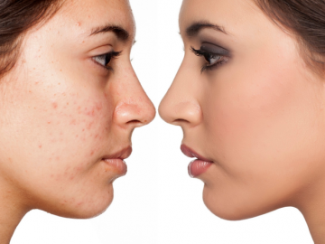 Điều trị mụn trứng cá hiệu quả nhất, không để lại di chứng trên da