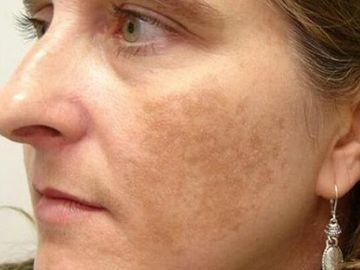 Sạm, nám da nhiều hơn sau điều trị và cách khắc phục
