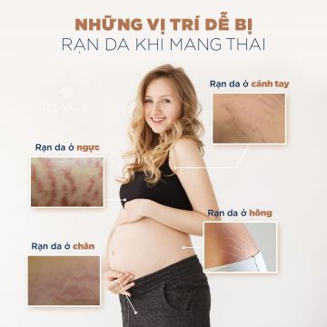 NHỮNG VỊ TRÍ DỄ BỊ RẠN DA KHI MANG THAI