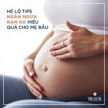 HÉ LỘ TIPS NGĂN NGỪA RẠN DA HIỆU QUẢ CHO MẸ BẦU