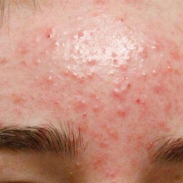 Thủ phạm gây mụn trứng cá không phải ai cũng biết