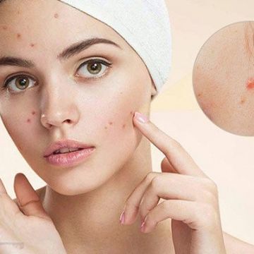 Phương pháp trị mụn mùa hanh hiệu quả