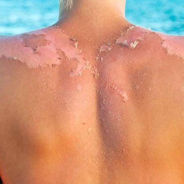 Chị em cần làm gì để tránh tác hại của ánh nắng mặt trời khi hè về?