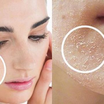 Nguyên nhân không ngờ khiến bạn da bị khô