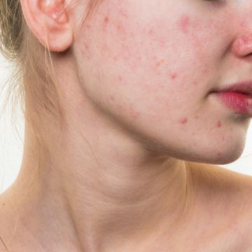 Sai lầm khiến da nổi mụn trường kỳ