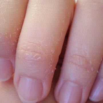 Khắc phục khô da tay khi dùng nước rửa tay nhiều