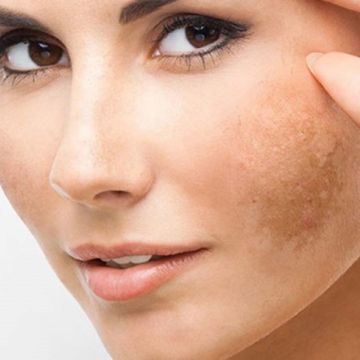 Ghim ngay những cách có thể loại bỏ đốm đen trên da cho bạn làn da sáng mịn