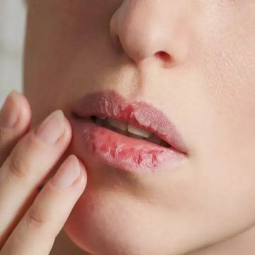 Các vấn đề về da thường gặp phải trong mùa đông