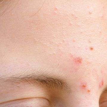 Lý do khiến bạn bị nổi mụn trên trán