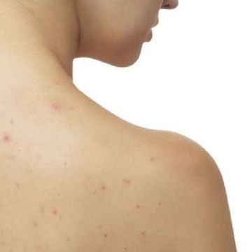 Mụn ở lưng trị thế nào cho đúng?