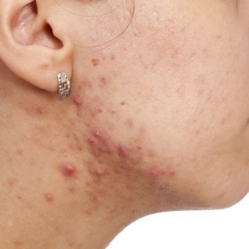 Sử dụng muối biển và chanh giúp bạn trị mụn cực nhanh