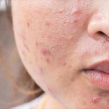 4 bệnh về da thường gặp khi thời tiết nắng nóng
