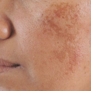 Khắc phục tăng sắc tố trên da hiệu quả