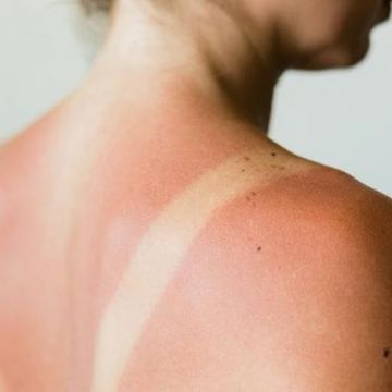 Bí quyết để da không tiết nhiều dầu trong mùa hè