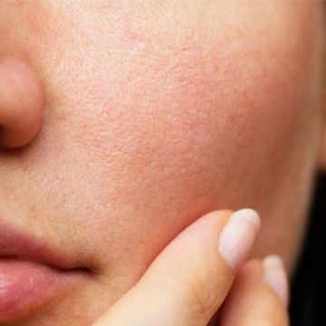 Bí quyết giúp bạn thu nhỏ lỗ chân lông tại nhà