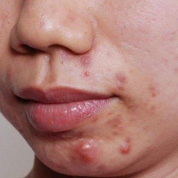 Các chất bổ sung hỗ trợ điều trị mụn trứng cá