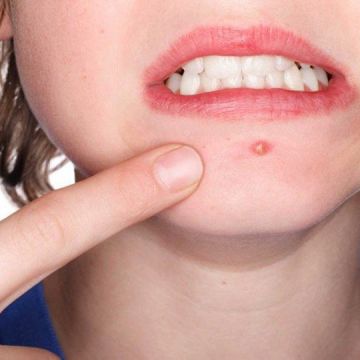 Mụn bọc ở cằm có nên nặn không?