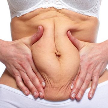 3 bước cải thiện vùng da bụng chảy xệ