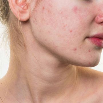 Điều bạn cần làm ngay khi bị dị ứng mỹ phẩm