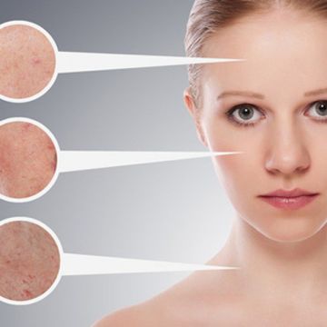 Điều trị lỗ chân lông to trên mặt thế nào?