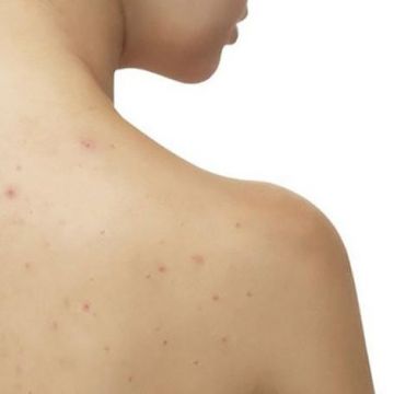 Lý do cứ nắng nóng lại dễ nổi mụn lưng