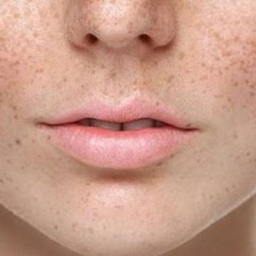 Phân biệt nám da và tàn nhang