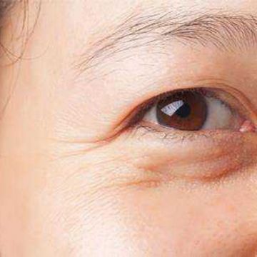 Các lựa chọn tốt nhất cho mí mắt sụp, chảy xệ