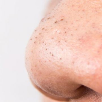 Nặn mụn đầu đen ở mũi thế nào cho đỡ hại da?