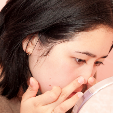 Nguyên nhân gây mụn ở mũi và cách điều trị