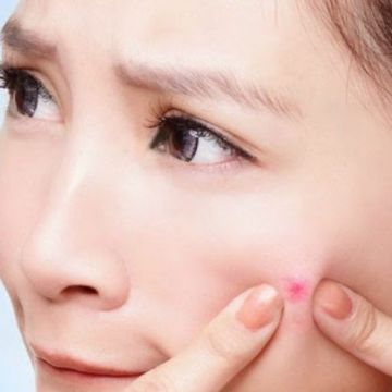 Những điều cần biết trước khi bạn nặn mụn