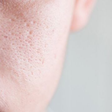 Mẹo thu nhỏ lỗ chân lông quá lớn