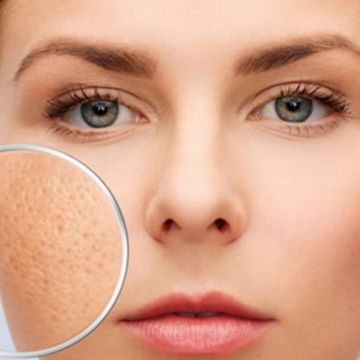 Nguyên nhân gây bít lỗ chân lông
