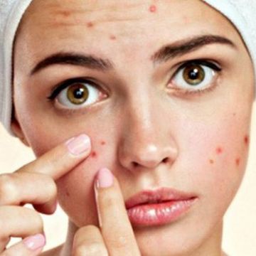 Nặn mụn xong nên làm gì để không bị thâm?