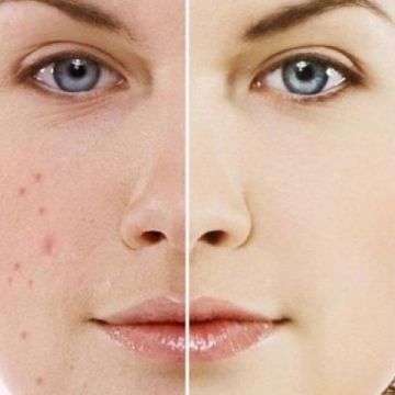 Cách chữa mụn trứng cá như thế nào?