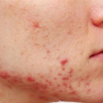 Bạn đã biết cách trị mụn do nội tiết gây ra?