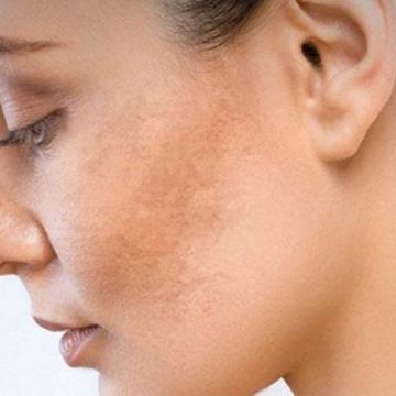 Thói quen sinh hoạt ảnh hưởng như thế nào đến làn da?