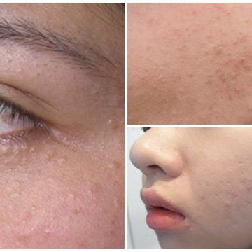 Chỉ với 3 bước mụn ẩn dưới da sẽ biến mất