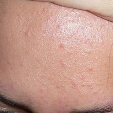 Mụn ẩn dưới da: Chữa trị không khó