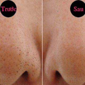 4 bước để mụn đầu đen không bao giờ tìm đến bạn