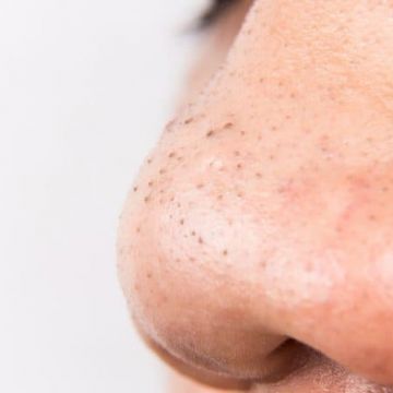 Lý do bạn bị mụn đầu đen mãi không khỏi