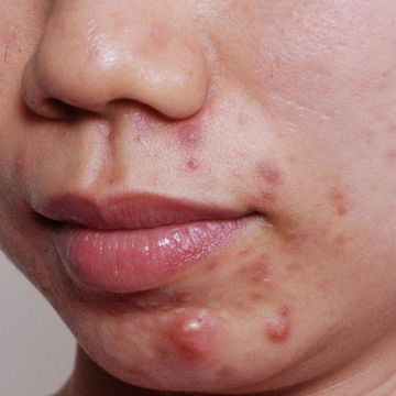 Chế độ dinh dưỡng cho người bị mụn trứng cá