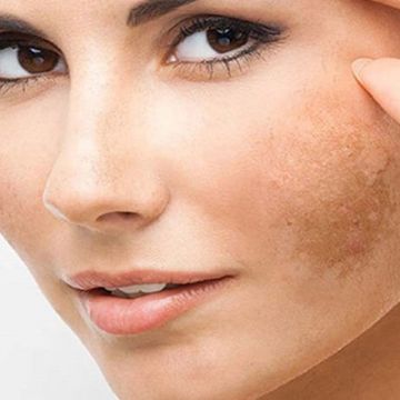 Nguyên tắc giúp bạn điều trị nám da thành công