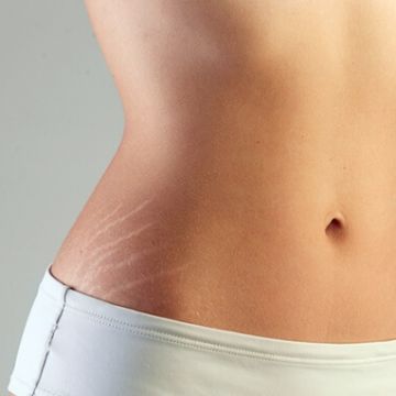 Mách bạn cách chữa rạn da hiệu quả ở tuổi dậy thì