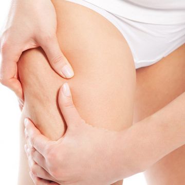 Rạn da ở tuổi dậy thì và cách phòng ngừa