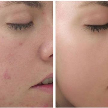 Quy trình trị mụn trứng cá tại nhà bạn phải nhớ