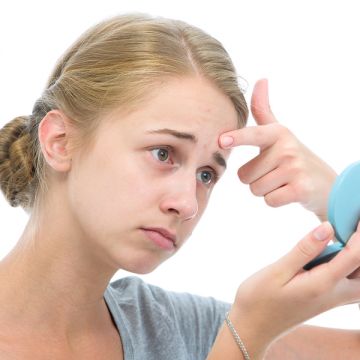 4 bí quyết chống lại mụn trong mùa hè