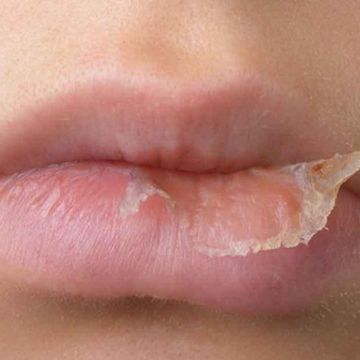 Xử lý môi khô khi giao mùa bạn phải biết