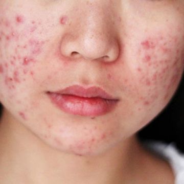 Chăm sóc da bị mụn trứng cá như thế nào?