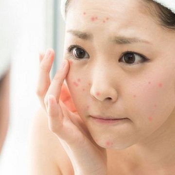 Lý do bạn mất tiền mua mỹ phẩm mà trị mụn không thành công